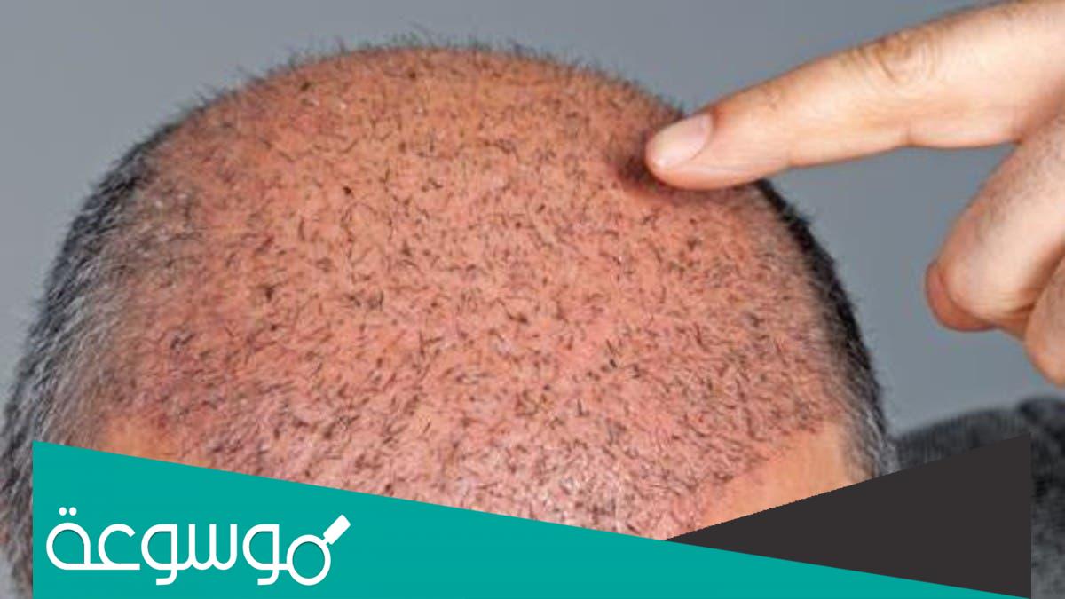 تفسير رؤية زراعة الشعر أو قصه في المنام